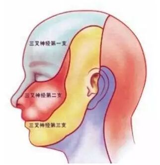 经颅磁刺激仪治偏头痛有效吗